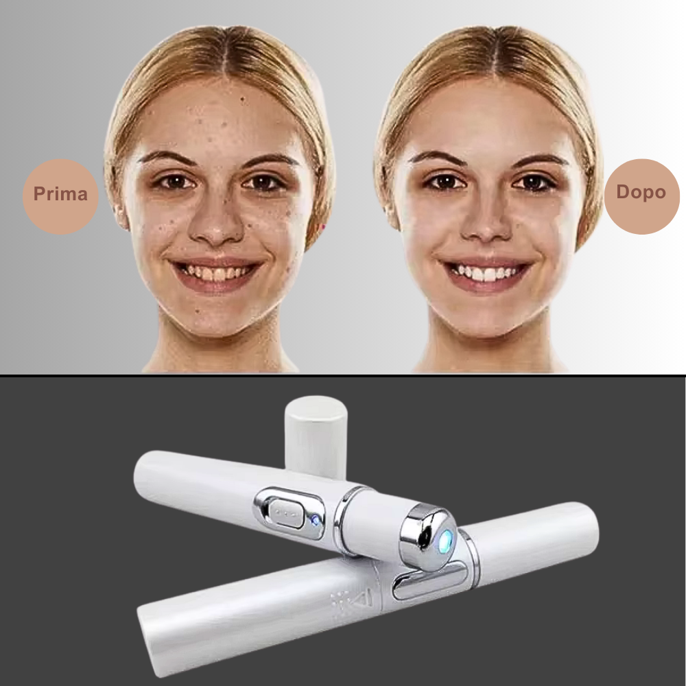 Penna Fotonica con luce blu 415 nm – Trattamento anti-acne avanzato e rigenerazione cutanea