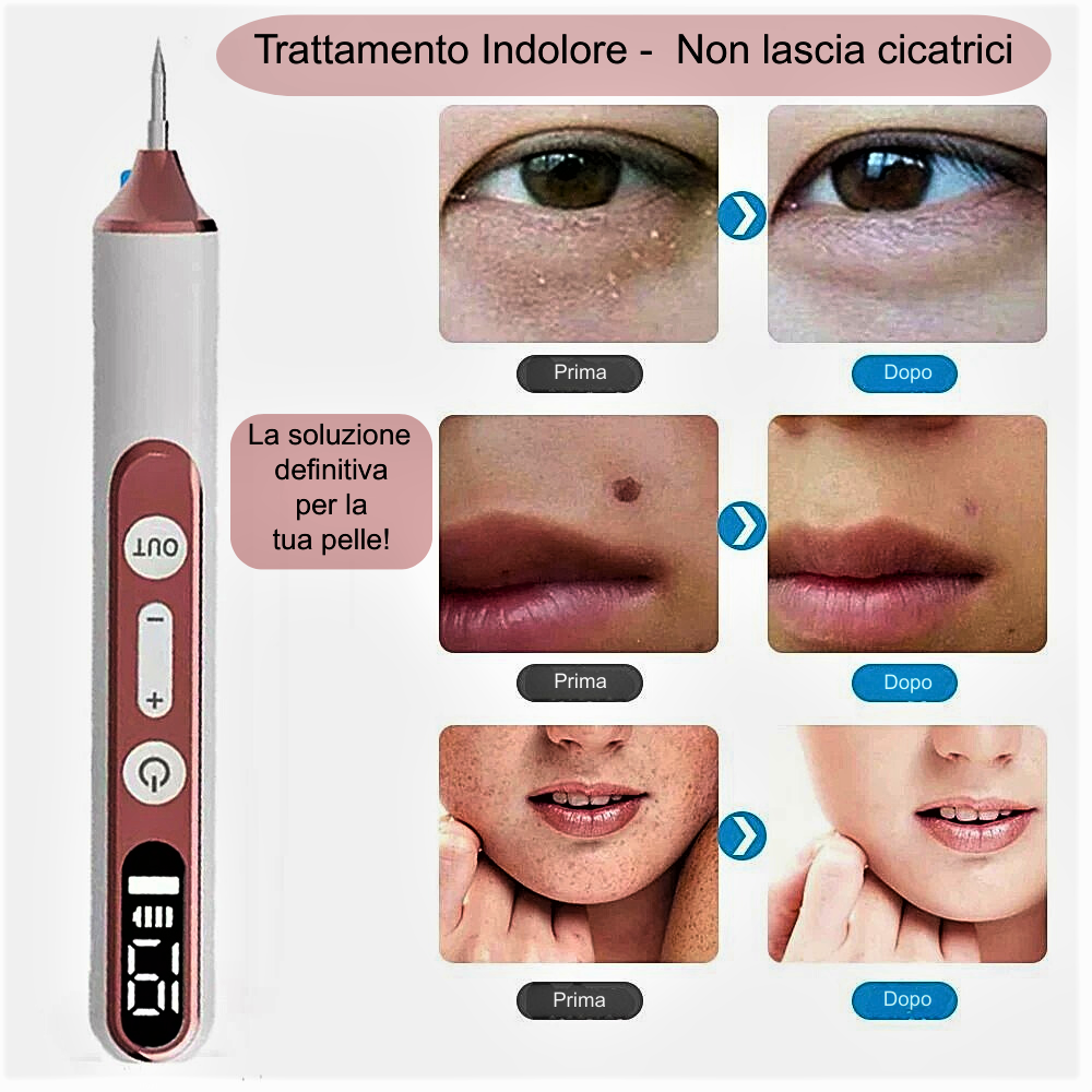 Penna Laser al Plasma – Rimozione Professionale di Imperfezioni Cutanee