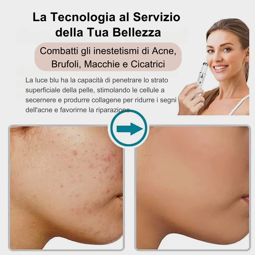 Penna Fotonica con luce blu 415 nm – Trattamento anti-acne avanzato e rigenerazione cutanea