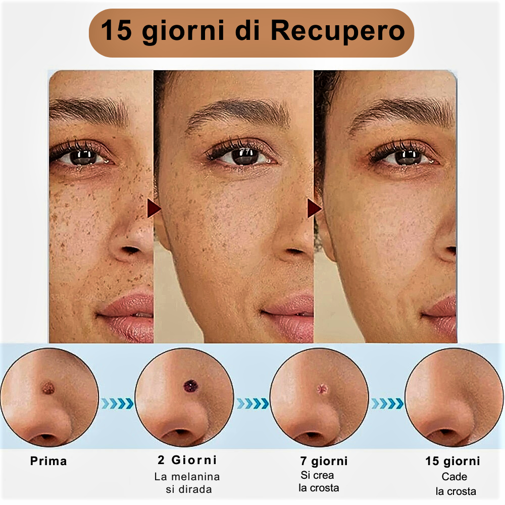 Penna Laser al Plasma – Rimozione Professionale di Imperfezioni Cutanee
