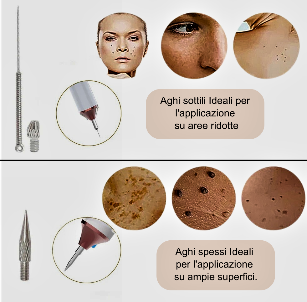 Penna Laser al Plasma – Rimozione Professionale di Imperfezioni Cutanee