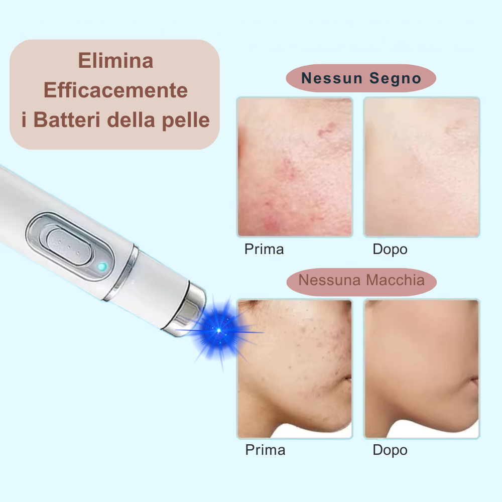 Penna Fotonica con luce blu 415 nm – Trattamento anti-acne avanzato e rigenerazione cutanea