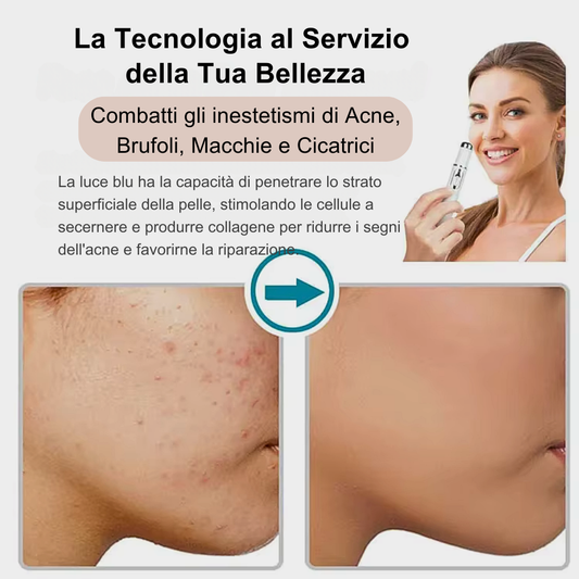Penna Fotonica con luce blu 415 nm – Trattamento anti-acne avanzato e rigenerazione cutanea
