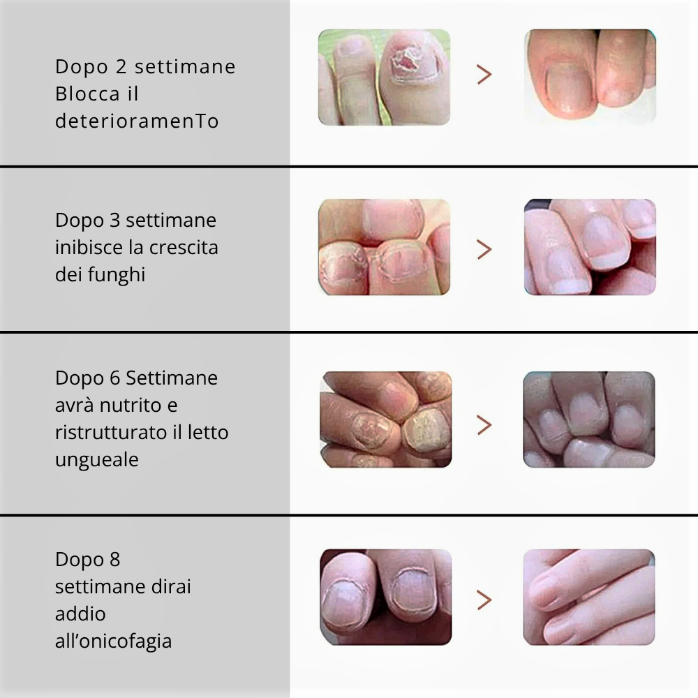 Cerotto Fitoterapico contro Funghi Ungueali