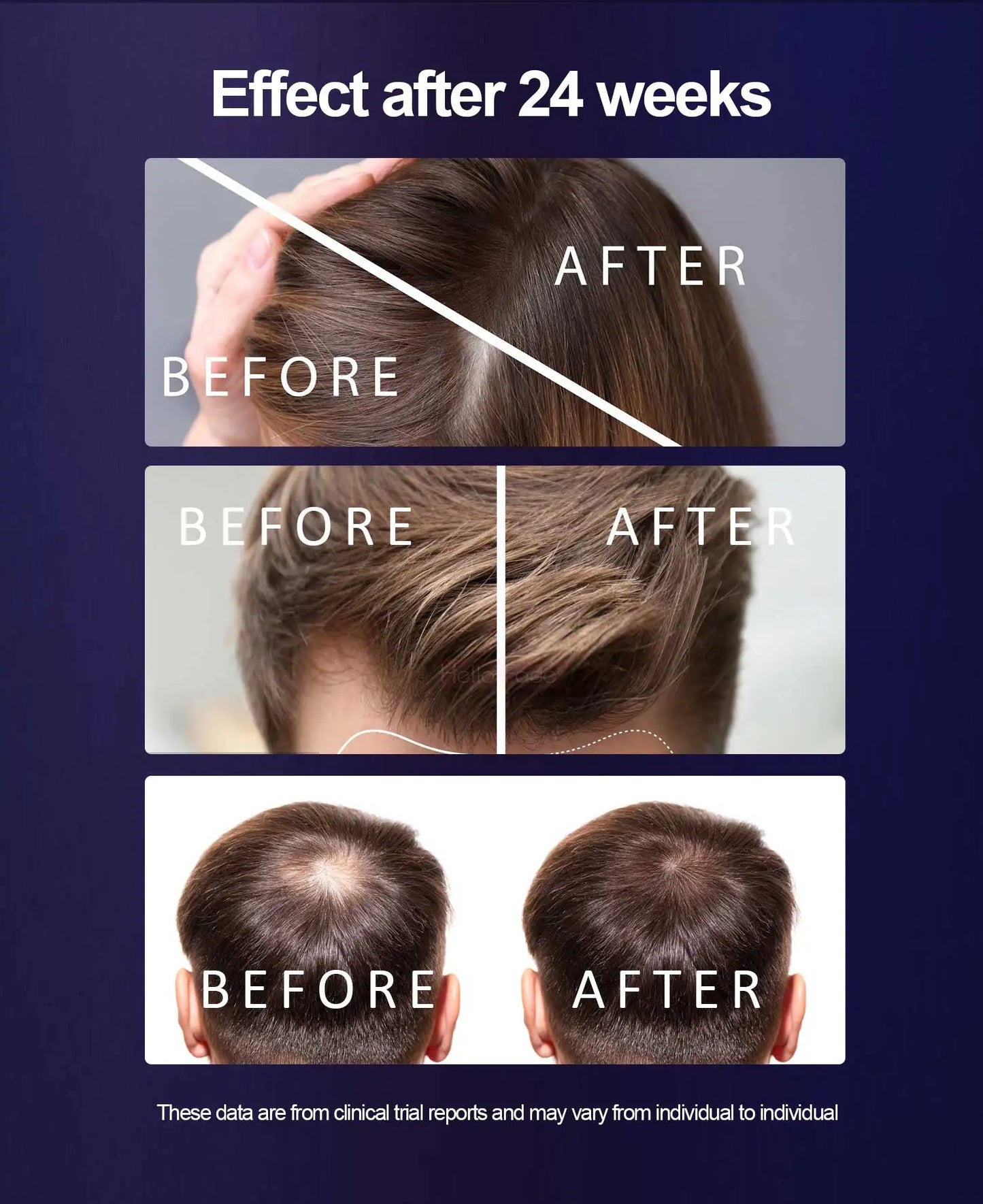 272 Laser Hair Growth Cap LLLT Therapy Red Light Scalp Health Device with Travel Bag for Hair Regrowth And Scalp Care